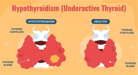 Hypothyroidism Causes Symptoms Treatment And Medication