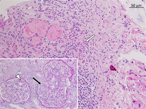 Anca Negative Eosinophilic Granulomatosis With Polyangitis Egpa