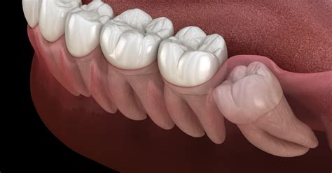 Impacted Wisdom Teeth Causes Symptoms And Treatment Options