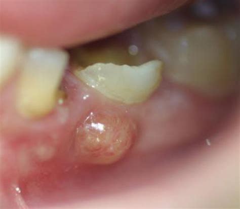 How To Pop A Dental Abscess By Yourself Hubpages
