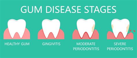 Know The Top 4 Causes Of Gum Recession Knoxville Common Reasons