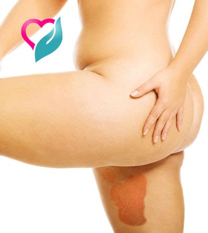 Rashes in the inner thighs can either be secondary to skin irritation from rubbing or a fungal infection from moisture. Causes, symptoms, and treatments for inner Thigh Rashes ...