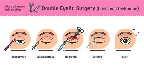 Double Eyelid Surgery In Korea Seoul Guide Medical