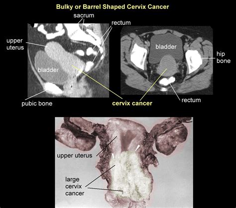 Can You See Cervical Cancer On A Ct Scan Cancerwalls