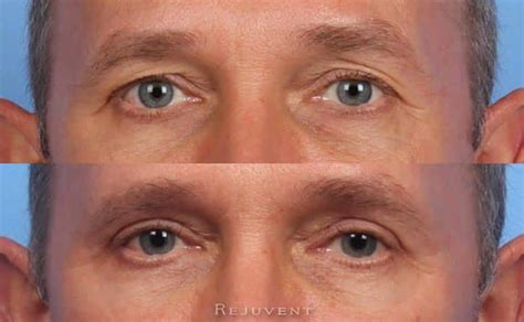 Lower Eyelid Blepharoplasty Photos • Rejuvent Medical Spa Scottsdale