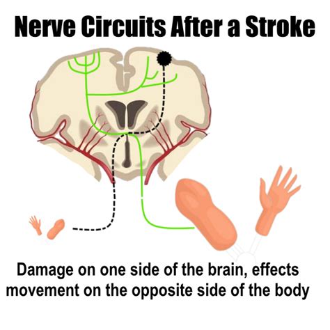 Rewire Your Brain After A Stroke Rehab Hq