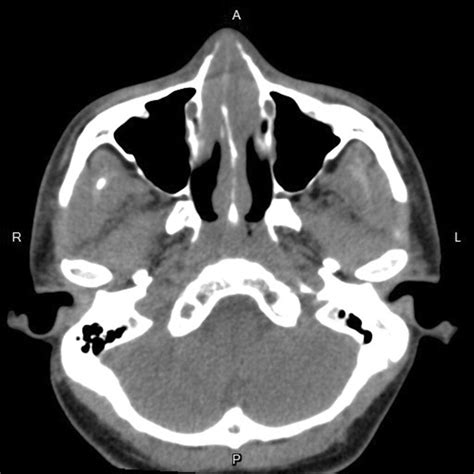 Contrasted Ct Scans Showed Bilateral Thickened Nasal Septal Mucosa With