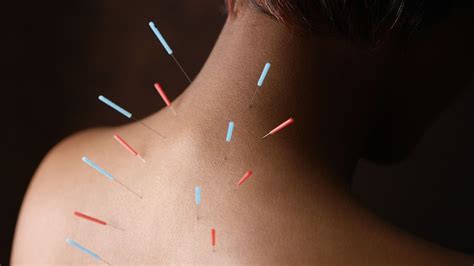 Can Acupuncture Treat Rheumatoid Arthritis Everyday Health