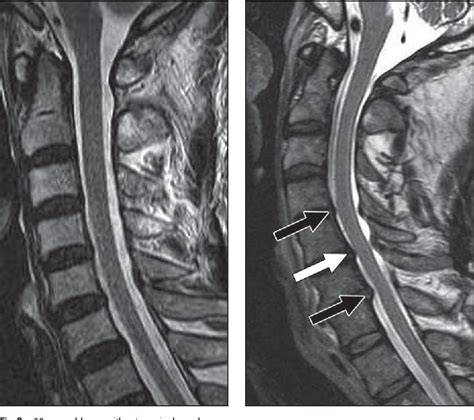Mri Cervical Spine Lumbar Spine Mri Scan Images Spinal Stenosis My