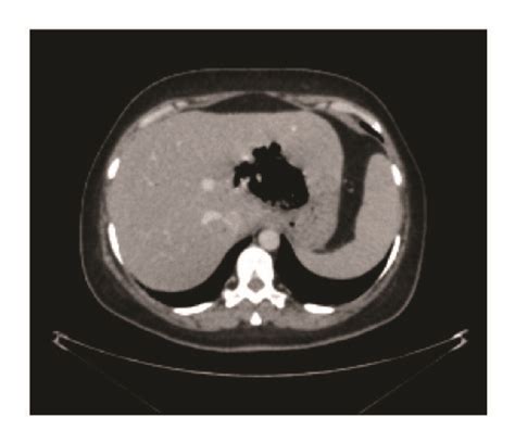 Axial Abdominal Ct Scan With Oral And Iv Contrast Mixed Collection