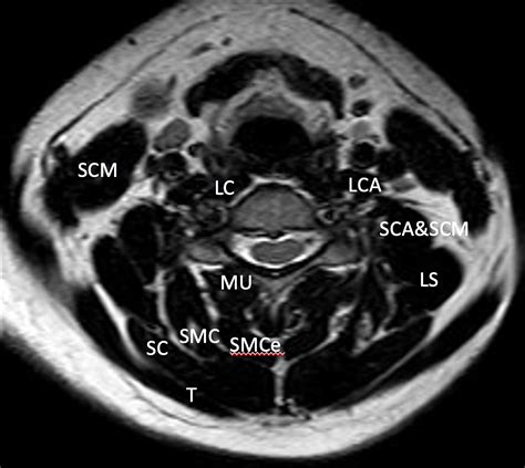 Mri Read Cervical Spine Axial View Anatomy Of Cervica