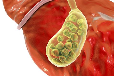 Gallbladder Inflammation Symptoms Signs Complications And Causes