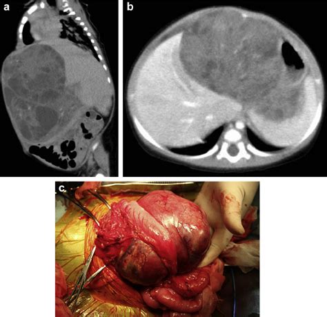 A Abdominal Ct Scan Shows A Cystic And Solid Huge Tumor With Local