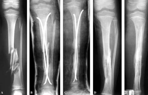A Open Grade 3a Segmental Fracture Of Both Bones Of The Left Leg