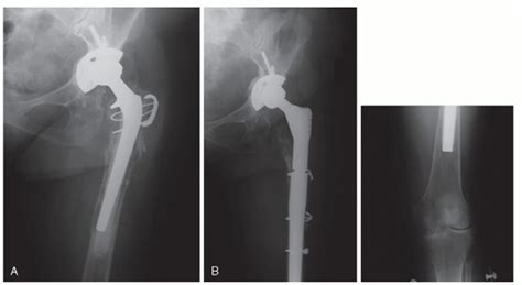 Fluted Tapered Modular Stems Musculoskeletal Key