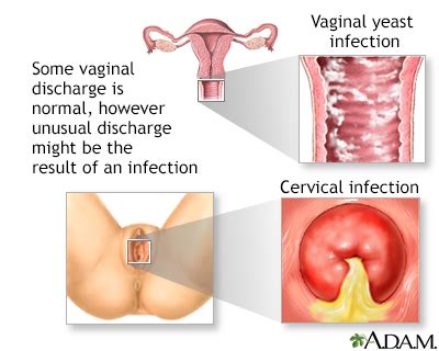 Vaginal Itching And Discharge Adult And Adolescent Information