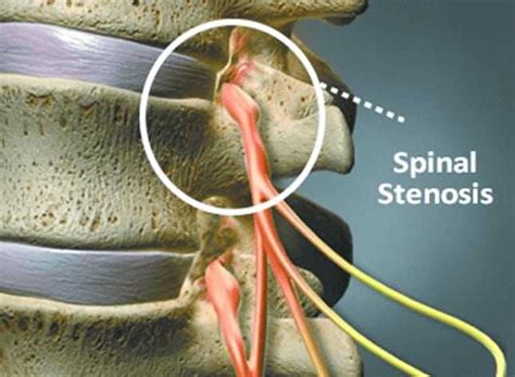 Spinal Stenosis Surgery Things You Should Consider