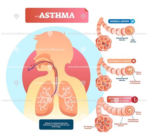 Asthma Anatomical Vector Illustration Infographic Diagram Asthma Body