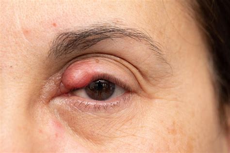 Premium Photo Chalazion On Ladys Eye Swelling And Inflammation Of