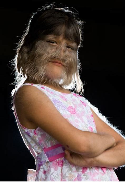 photo 世界一毛深い女の子としてギネスに認定された、タイの11歳の狼少女 b side of cia