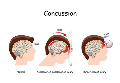 Concussions In Women Can Have Lasting Effects Premier Neurology And Wellness Center