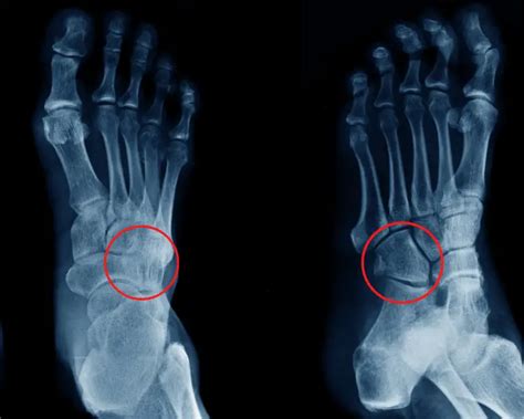 Cuboid Fractures Of The Foot A Helpful Guide