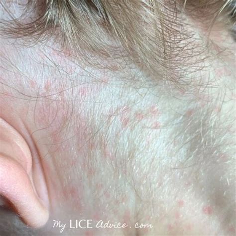 17 Lice Symptoms With Pictures Signs That You Have Head Lice My Lice