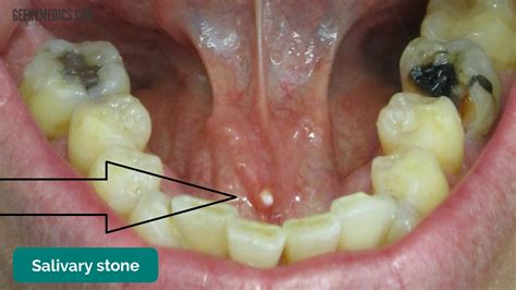 Sores In Floor Of Mouth