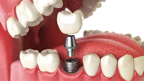 Cinco Tipos De Procedimentos De Odontologia Estética