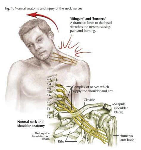 Brachial Plexus Injury Symptoms