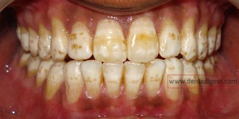 Severe Dental Fluorosis Dental Fluorosis Dental Dental Veneers