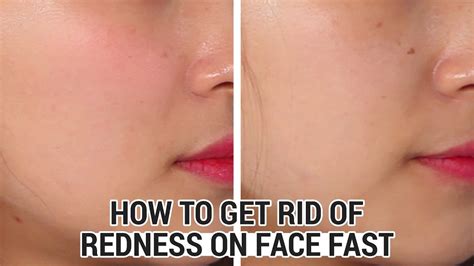 How To Get Rid Of Redness On Face Home Remedies Diewanddesigner