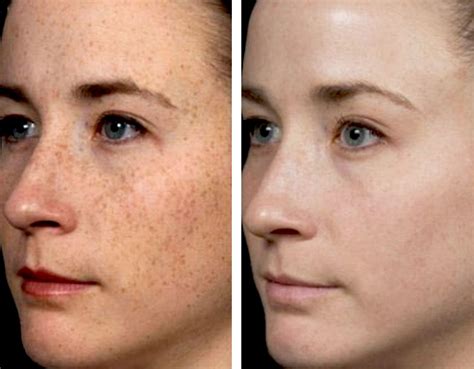 Fraxel Laser Resurfacing Costs And Side Effects Spots On Face Age