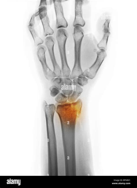 X Ray Of A Comminuted Distal Radius Wrist Fracture Stock Photo Alamy