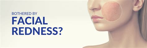 Facial Redness Treatment At Cutis Laser Clinics Singapore