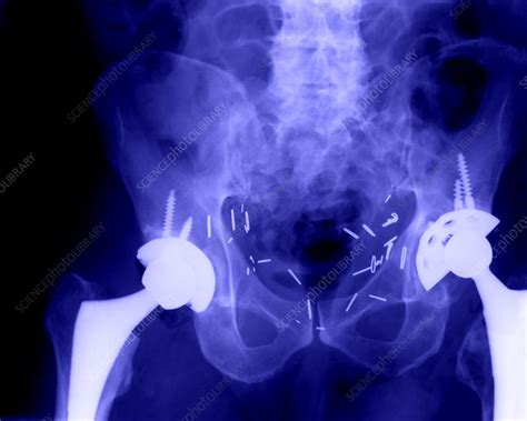 Double Hip Replacement Stock Image M6000305 Science Photo Library