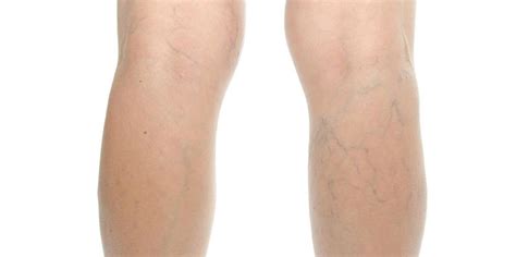 Frequently Asked Questions About Varicose Veins Transits Blog