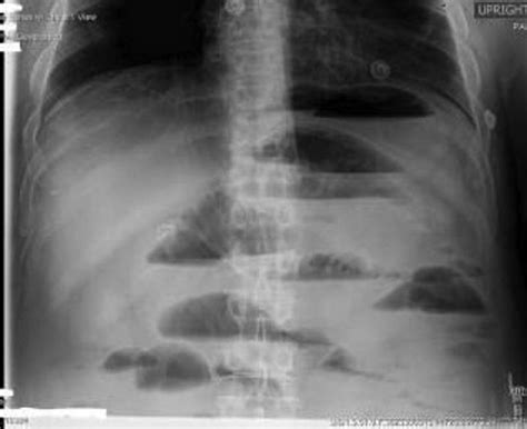 Erect Abdominal Radiograph Showing Multiple Air Fluid Levels