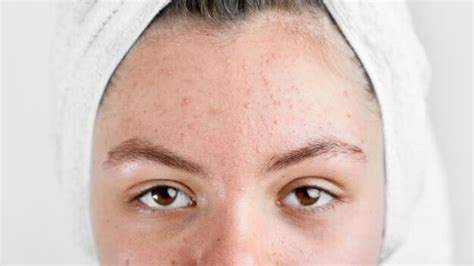 Learn How Dry Skin Causes Acne The 6 Main Reasons You Didnt Know ⬅️