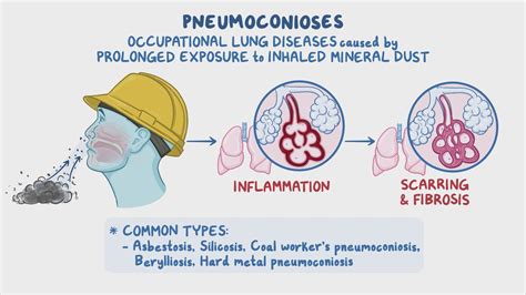 Approach To Pneumoconiosis Clinical Sciences Osmosis Video Library