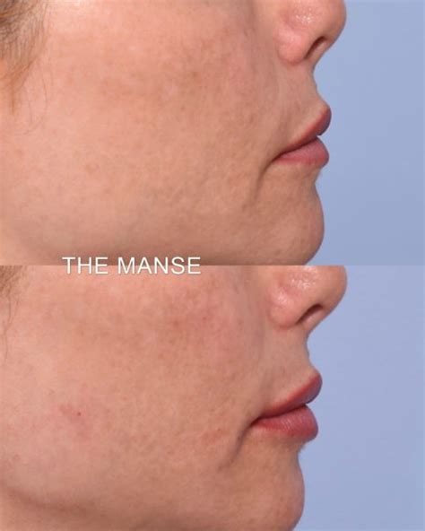 lip profile images after dermal fillers best clinic sydney for dermal fillers