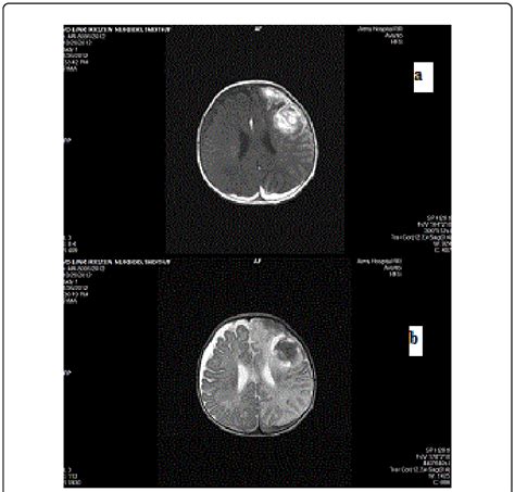 A Ti Weighted Image Showing Hyperintensity In The Left Frontal Lobe