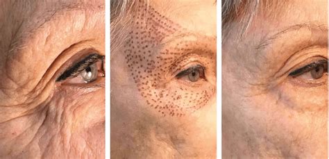 Before And After Blepharoplasty Plasmage The London Facial Care