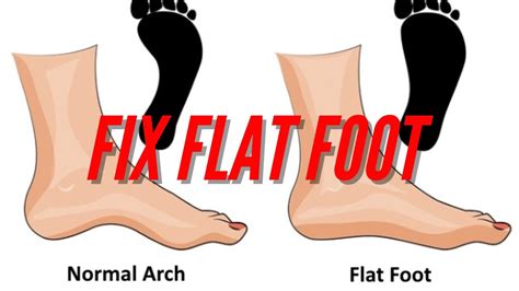 Wowhow To Fix Flat Foot Youtube