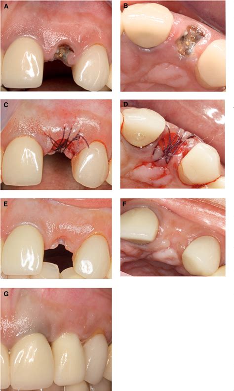 Tooth Extraction Bone Graft Healing Stages Pics SexiezPicz Web Porn