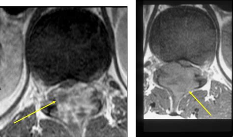 Osteoblastoma Bone Tumor Cancer Tumors Of The Bone