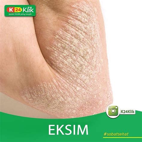 Eksim kering adalah penyakit yang membuat kulit menjadi kering, merah, dan gatal. k24klik.com - Apotek Online Paling Komplit — [ EKSIM ...