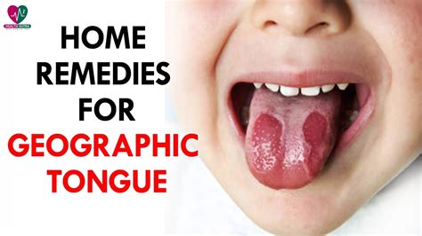 Home Remedies For Geographic Tongue Health Sutra Youtube