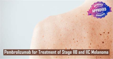 Pembrolizumab For Adjuvant Treatment Of Stage Iib Or Iic Melanoma