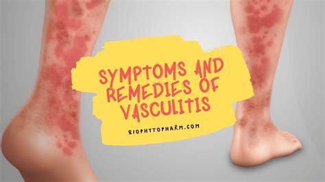 Symptoms And Remedies Of Vasculitis Biophytopharm